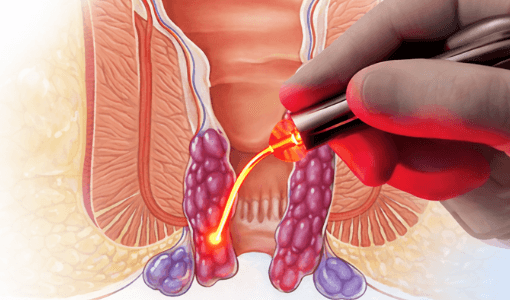 Piles, Fissure & Fistula Hospital Pimple Saudagar