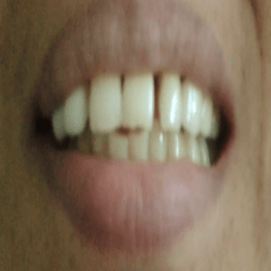 Crowns treatment -after