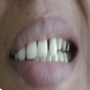 Crowns treatment - before