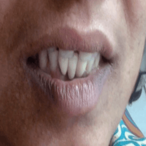 dental implant -after