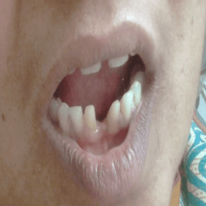dental implant -after